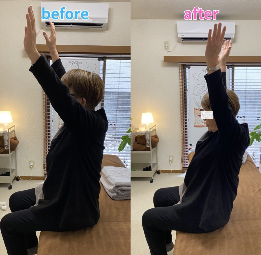 四十肩・五十肩＋腱板損傷